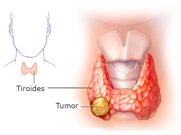 Cancer de tiroides