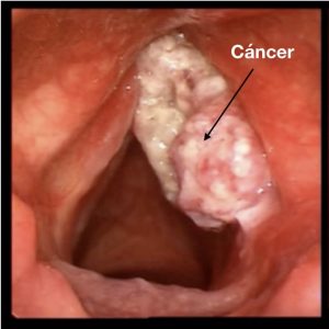 cancer de laringe2